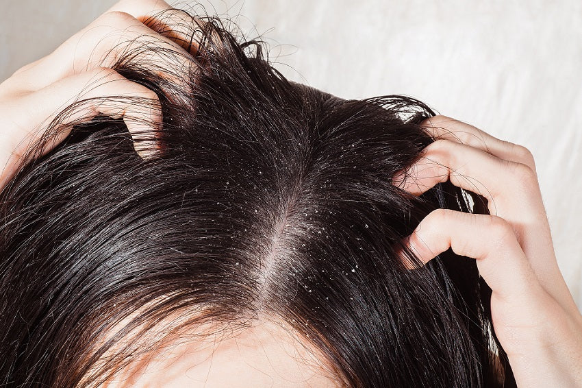 Hair Care 101: Dry Scalp Treatments
